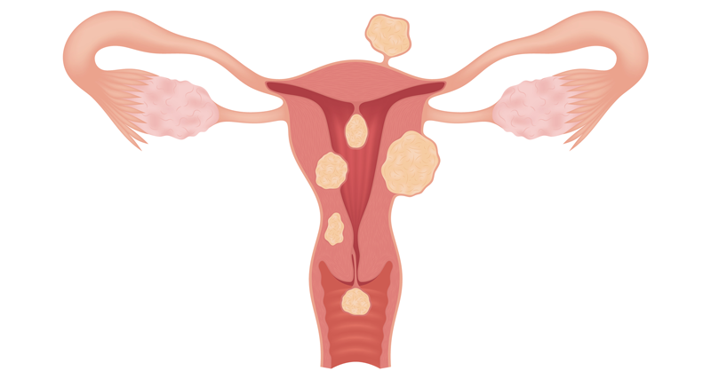 Ilustração de útero doente como miomas e pólipos | Instituto Kemp